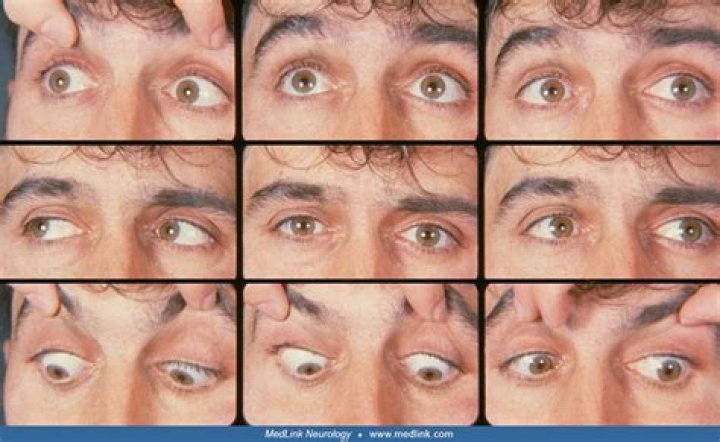 What causes gaze palsy